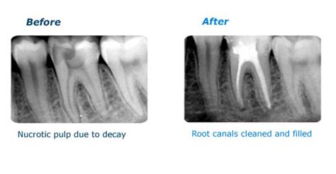 Need a Root Canal?