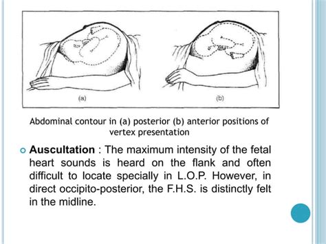 Occipito posterior position