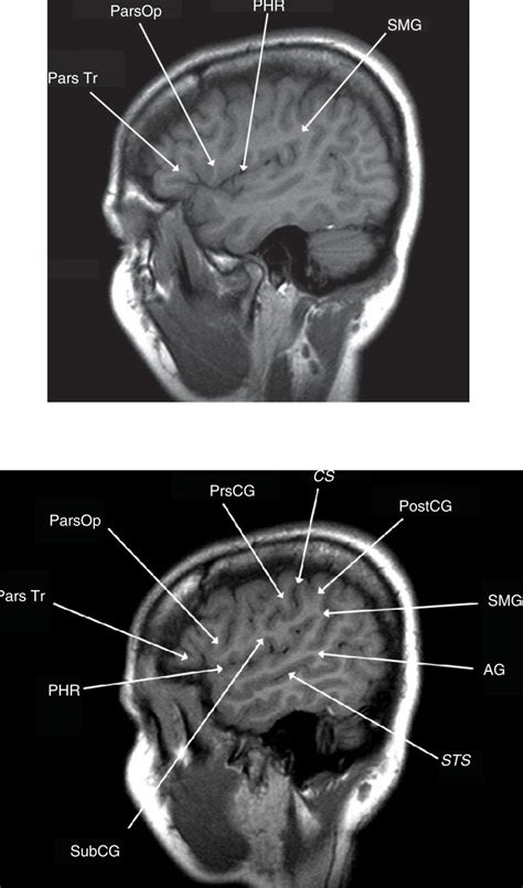 Figures 3, [Lateral sagittal T1-weighted MRI scans...]. - Glioblastoma - NCBI Bookshelf