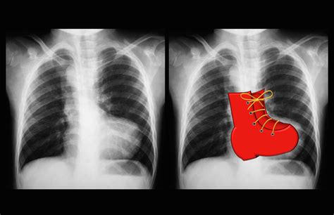 Pulmonic regurgitation Chest X-Ray - wikidoc