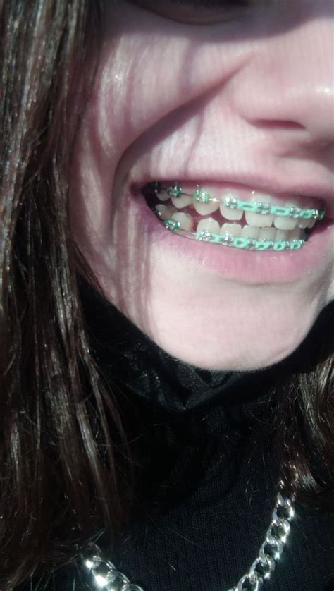 #braces #minty | Braces colors, Green braces, Braces cost