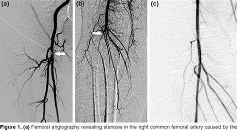 Figure 1 from Acute arterial occlusion due to vascular closure device ...