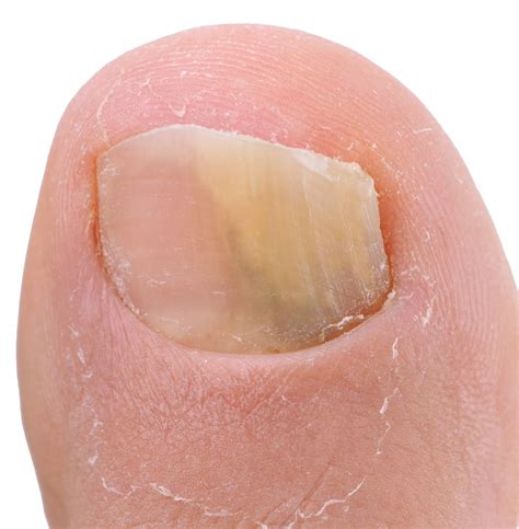 Thick, discolored nail. Is it a Fungus? | Center Grove Foot & Ankle Care