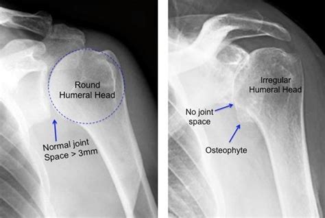 Boston Shoulder Institute – normal v arthritis 1(2)