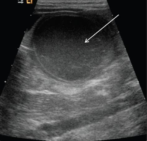 Hemorrhagic Cyst Ultrasound