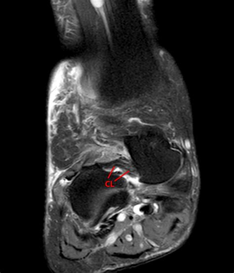 Sinus Tarsi Syndrome Mri