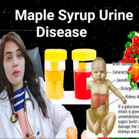 Maple Syrup Urine Disease | Health And Nutrition | Nutritionist Puja Ukey