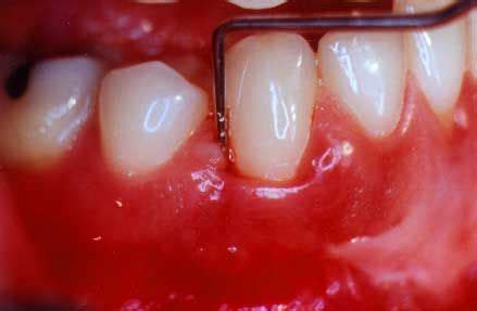 Gum swollen. Link: http://www.dental-public-health.com/periodontal-disease.html Link: www ...