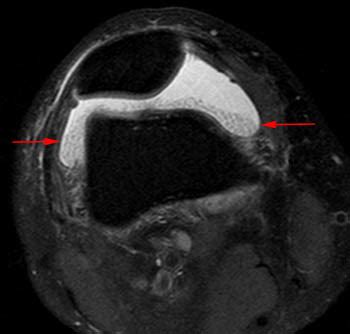 Lipoma Arborescens | Radsource