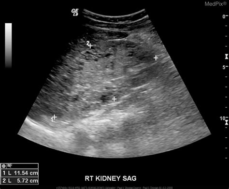 Infantile Polycystic Kidney Disease Ultrasound