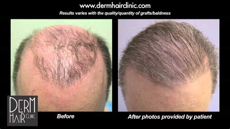 Beard Hair to head Transplant using 5000 grafts for FUE Repair