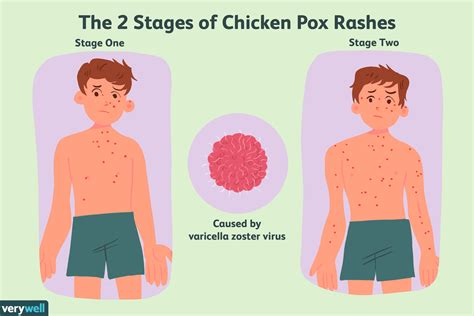 Chicken Pox Stages