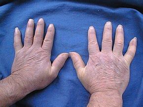 Scleroderma - Wikipedia