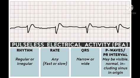 EKG PEA (Pulseless electrical activity) - YouTube