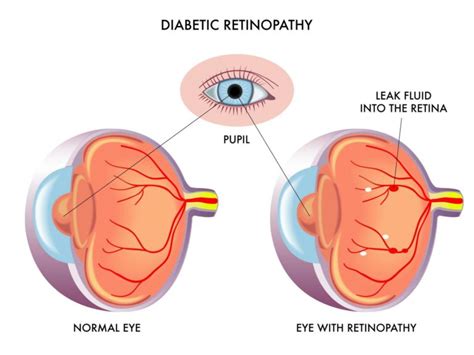 Diabetic Retinopathy Laser Surgery | Boca Raton & Coral Springs