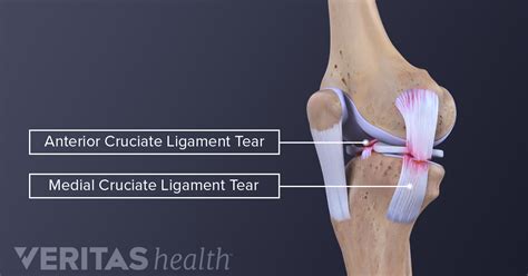 Medial Collateral Ligament (MCL) Tears and Sprains