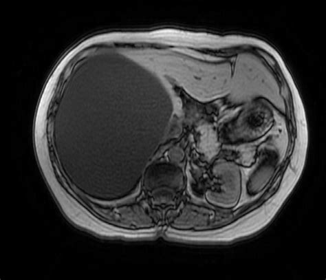 Hepatic cysts diagnostic criteria - wikidoc