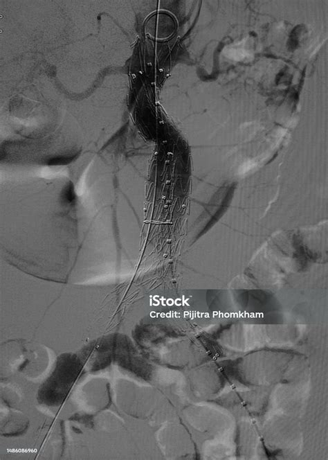 Endovascular Aneurysm Repair Procedure Stock Photo - Download Image Now - Cardiovascular System ...