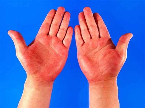 What Your Hands Can Tell You About Your Health | hubpages