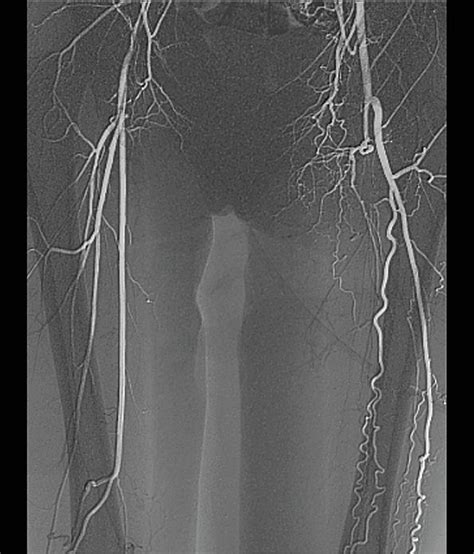 Blocked Femoral Artery Photograph by Zephyr/science Photo Library | Pixels