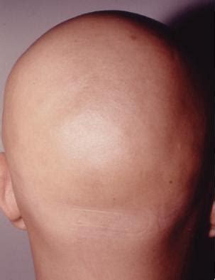 US Hair Transplant » alopecia universalis