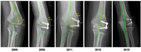 Guided Growth for the Treatment of Cubitus Varus in Children: Medium ...