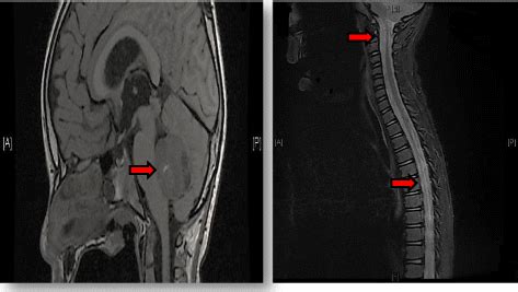 Brain and spine MRI showed a midline posterior fossa tumor suggestive ...