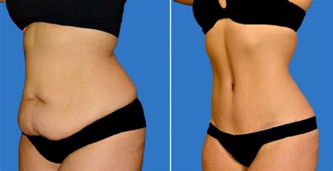 Loose Skin Removal Surgery Costs, Scars and Risks - Skincarederm