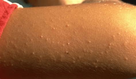 Does Keratosis Pilaris Itch? | Vujevich Dermatology Associates