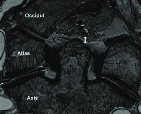 The alar ligaments in coronal section acquired using imaging at 4.6T ...