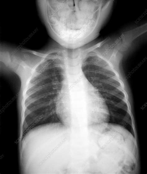 Normal heart and lungs of a child, X-ray - Stock Image - P590/0298 - Science Photo Library