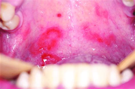 Benign Hard Palate Lesions