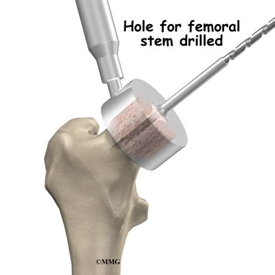 Hip Resurfacing Arthroplasty - eOrthopod.com