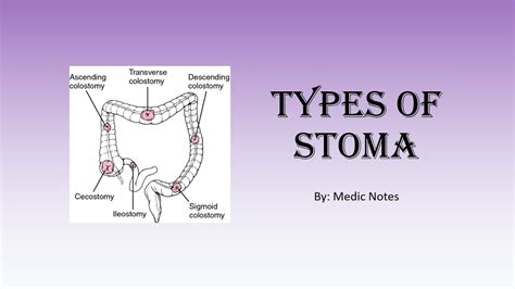 Types of stoma - colostomy/ileostomy/urostomy, end/loop/double-barrel, temporary/permanent - YouTube