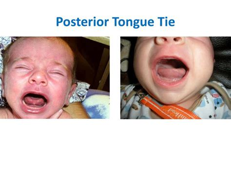 PPT - Jill Rabin M.S. CCC-SLP/L IBCLC Pediatric Speech/Language ...