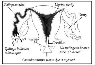 What is a Hysterosalpingogram (HSG)? | Shady Grove Fertility