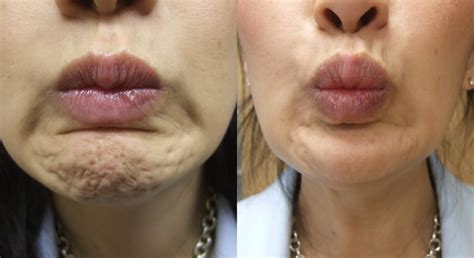 Botox Results | DM Cosmetic and Wellness