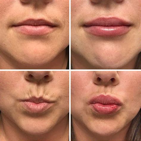 What to Know About Lip Fillers and How to Choose the Best One for You