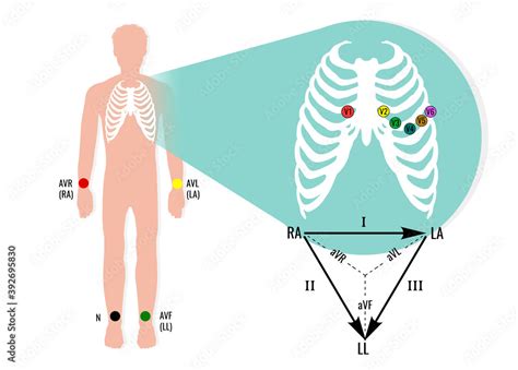 Ecg electrode position illustration with ecg limb leads. Useful for educating doctors and nurses ...