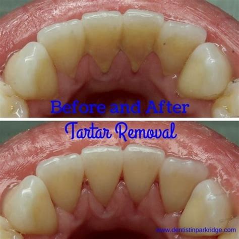 Smile Gallery | Tartar removal, Teeth cleaning, Plaque teeth