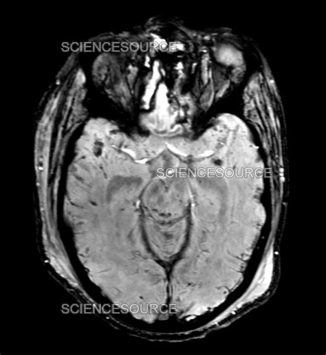 Traumatic Brain Injury MRI | Stock Image - Science Source Images