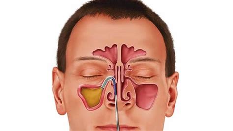 Sinusitis: Paranasal Sinuses, Symptoms, Causes, Risk Factors, Types ...