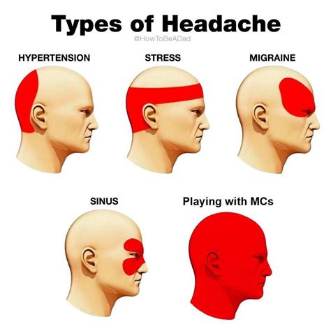 Types of headache : r/AdmiralBulldog