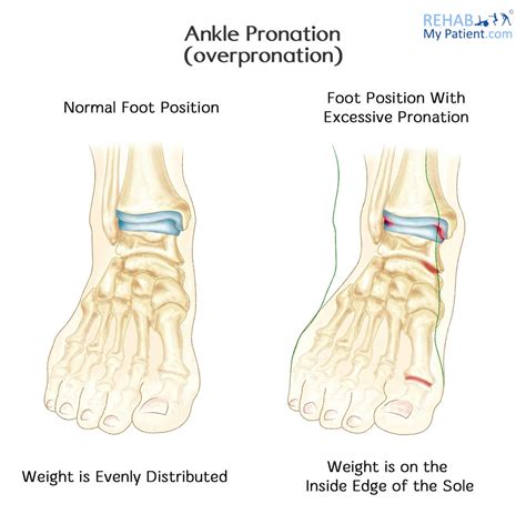 What Causes Pronation Of Foot