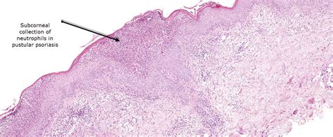 Dermatopathology Made Simple - Inflammatory: Pustular Reaction Pattern