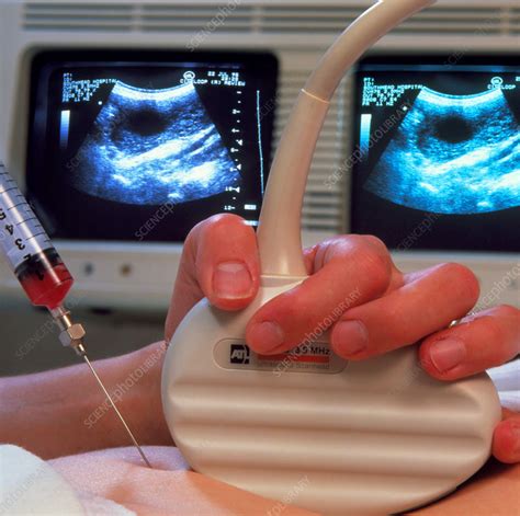 Chorionic villus sampling with needle & ultrasound - Stock Image - M800/0037 - Science Photo Library