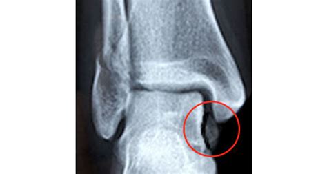 What Causes An Avulsion Fracture Ankle Fracture Avulsion Fracture ...