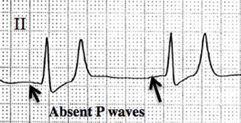 The P Wave ECG Basics MedSchool, 59% OFF