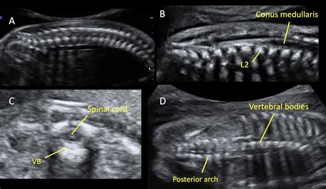 Spina Bifida 3d Ultrasound