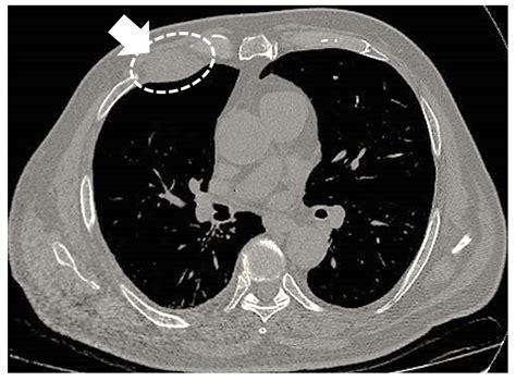 Mesothelioma